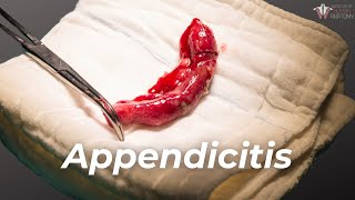 What should one avoid amp have post Appendix Surgery  Dr Viswanath S [upl. by Nodlew]