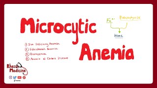 MICROCYTIC ANEMIA Iron Deficiency Anemia Anemia of Chronic Disease Sideroblastic Anemia  Rhesus [upl. by Nodearb]