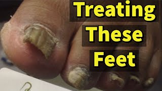 Treating These Feet A Patient With Fungal Toenails [upl. by Salema]