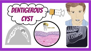 ORAL PATHOLOGY  DENTIGEROUS CYST [upl. by Shaughn]