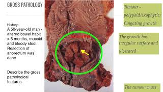 Colorectal Cancer Surgery principles and types [upl. by Odie]