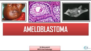 Ameloblastoma  Benign Odontogenic Tumor [upl. by Tigdirb]