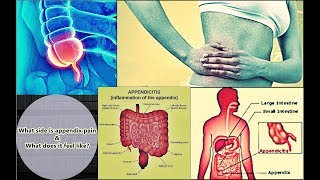 Appendix Pain  Location Symptoms Treatment Causes [upl. by Jaehne]