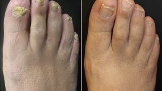 Toenail Fungus Treatment Listerine Home Cure [upl. by Maryl389]