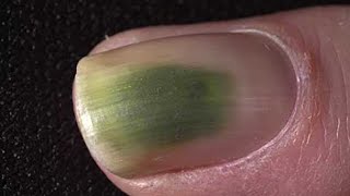 Green Toenail Fungus Cure Home Treatment Guide [upl. by Lenny421]