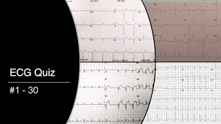 ECG Quiz 1  30 [upl. by Herve]