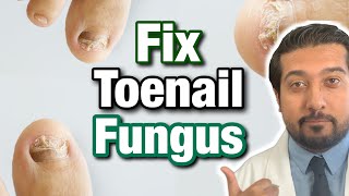 How to Treat Toenail Fungus CORRECTLY  Easy Steps 2021 [upl. by Athey]