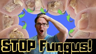 How to CURE Yellow Toenail Fungus amp Toe Fungus Remedies amp Treatment [upl. by Shepard]