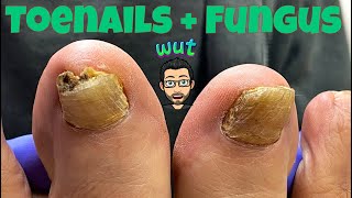 HOW TO CUT THICK TOENAILS WITH FUNGUS [upl. by Alake]