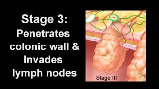 Chemotherapy in Colorectal Cancer [upl. by Meryl]