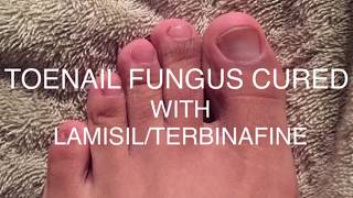 Toenail Fungus BeforeAfter  LamisilTerbinafine 2019 [upl. by Maryellen]