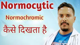 normocytic normochromic in hindi  Normocytic anemia  RBC indices in hindi [upl. by Eirrem687]