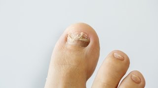 How to prevent and treat nail fungus [upl. by Ojybbob]