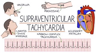 Understanding Supraventricular Tachycardia SVT [upl. by Lyman]