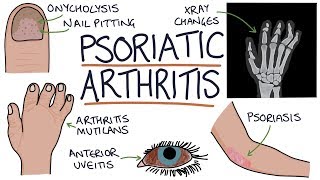 Psoriatic Arthritis [upl. by Ruby]