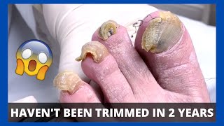 CUTTING AND GRINDING CRAZY TOENAILS  Toe Fungus Journey [upl. by Gnirps]