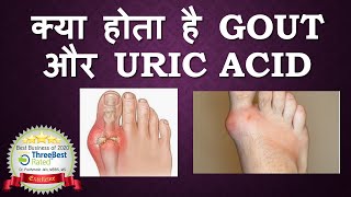 Gout and Uric Acid Hindi [upl. by Dream]