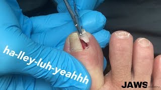 REMOVING A LARGE INGROWN TOENAIL [upl. by Betthel]