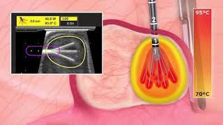 Acessa Procedure Quick Overview Animation [upl. by Ivets]