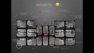 The Full Mouth Xray Survey Identification amp Film Mounting [upl. by Annaiuq]