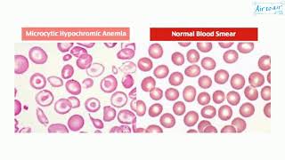 microcytic hypochromic anemia [upl. by Sorensen]