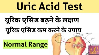 Uric Acid Test in Hindi  uric acid treatment  uric acid symptoms [upl. by Ronoc537]