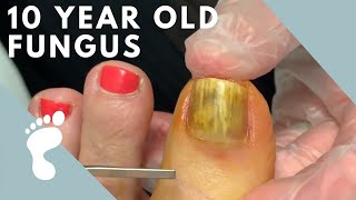 Fungus Takes Over Toenail  Toenail Removal [upl. by Sparks]