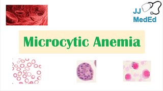 Microcytic Anemia amp Causes Iron Deficiency Thalassemia Anemia of Chronic Disease Lead Poisoning [upl. by Ahsad]