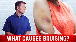 What Causes Bruising Without Trauma – Dr Berg [upl. by Yedrahs591]