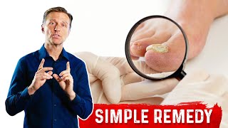 Use Epsom Salt For Toenail Fungus  Treatment For Toenail Fungus – DrBerg [upl. by Thirza]